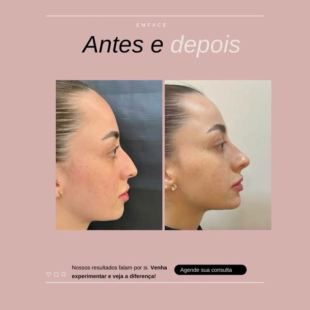 Exemplo de resultado de perfiloplastia publicado pela EMFACE